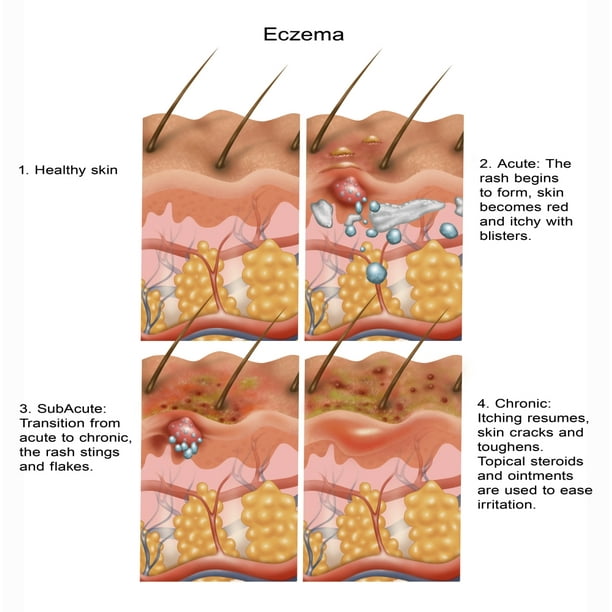 Eczema Poster Print by Gwen ShockeyScience Source - Walmart.com ...