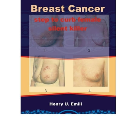 Breast Cancer: Step to curb female silent killer -