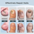 thumbnail image 4 of Nail Fungus Laser Device for Multiple Toenails & fingernails, Nail Repair Solution for Damaged and Discolored Nails, 4 of 5