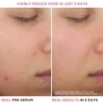 thumbnail image 4 of Sérum para el tratamiento del acné IT Cosmetics Bye Bye Breakout 30 ml, 4 of 7