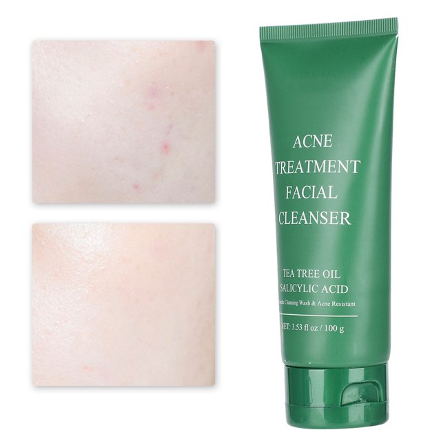 Facial cleanser acne treatment facial cleanser blackhead removal cleanser deep cleaning facial cleanser oil control face cleanser BREYLEE 100g Acne Treatment Facial Cleanser Deep ANGGREK Otros