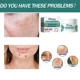 thumbnail image 5 of Crema eficaz para pecas, ilumina rápidamente la cara, elimina el Melasma, las manchas oscuras, desvanece la melanina, blanquea la pigmentación, mejora la luminosidad, 5 of 5