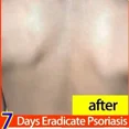 thumbnail image 5 of Crema de hongos para la piel saludable más efectiva, pomada de hierbas naturales, crema antibacteriana para tratar la psoriasis, dermatitis, eczema, 5 of 5
