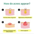 thumbnail image 4 of Clearance!Maojin Eliminación de cicatrices de acné facial Cne, 4 of 9