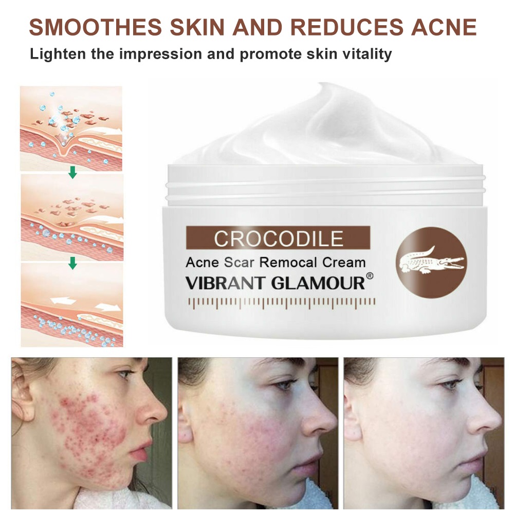 cream for removing acne spots