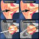thumbnail image 5 of Sdigv Ear Wax Removal - Electric Ear Cleaner - Ear Cleaning Kit - Ear Irrigation Kit Safe Ear Irrigation Flushing System With 4 Pressure Settings - Ef, 5 of 5