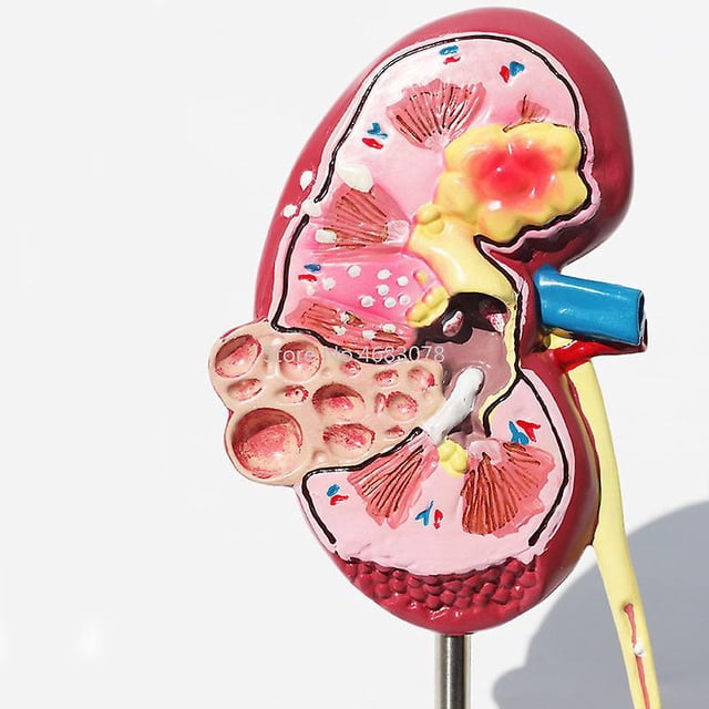 Organo Rinon Órgano médico riñón modelo anatómico lesión riñón modelo anatomía ...