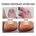 thumbnail image 3 of Paquete de 3 aceites para aliviar la paroniquia Toenailplus, aceite para el tratamiento de corrección de uñas de los pies para el crecimiento de las uñas, aceite para aliviar la paroniquia Toenai, 3 of 5