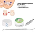 thumbnail image 4 of Toe Nail Correctors Tool, Comfortable Ingrown Toenail Corrector 3pcs Standard Design 17mm-22mm Adjustable  For Feet, 4 of 8