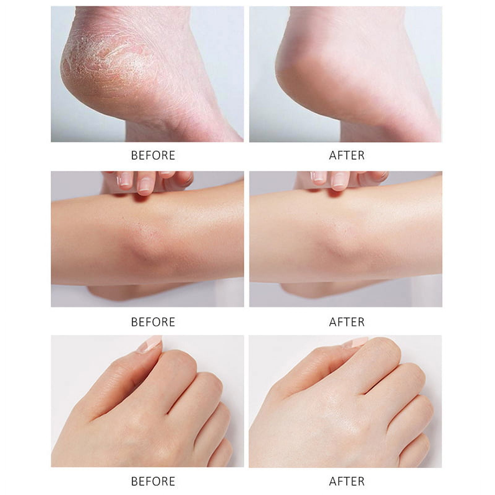 XIFEPFR Callus Remover, Foot Scrubber Dead Skin Remover, Exfoliating Foot  Spray, Spa Pedicure Treatment with Foot File, Cracked Heel Repair Cream
