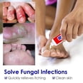 thumbnail image 4 of Crema para Psoriasis, pomada para Dermatitis, Eczema, partes privadas, picazón, Eczema, exfoliación roja, Antibiosis, crema Médica China para la piel, 1-3-5 Uds., 4 of 4