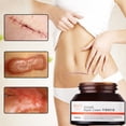 thumbnail image 2 of Scar Removal Stretch Marks Relief and Burns Acne Mark Removal, 2 of 5