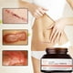 thumbnail image 2 of Scar Removal Stretch Marks Relief and Burns Acne Mark Removal, 2 of 5