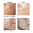 thumbnail image 6 of Pimple Eraser Acne Pad with Anti-Aging Glycolic Treatment By Miracle Care, FREE of CHEMICALS & DRUGS  1.33oz, 6 of 10