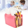 thumbnail image 2 of Modelo de dientes Octpeak Estudio de comparación de caries Saludable, 2 of 7