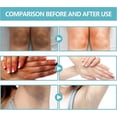 thumbnail image 5 of Crema para el tratamiento de la acantosis nigricans, crema reparadora de la piel con espinas negras, crema hidratante blanqueadora correctora de manchas oscuras, 5 of 5