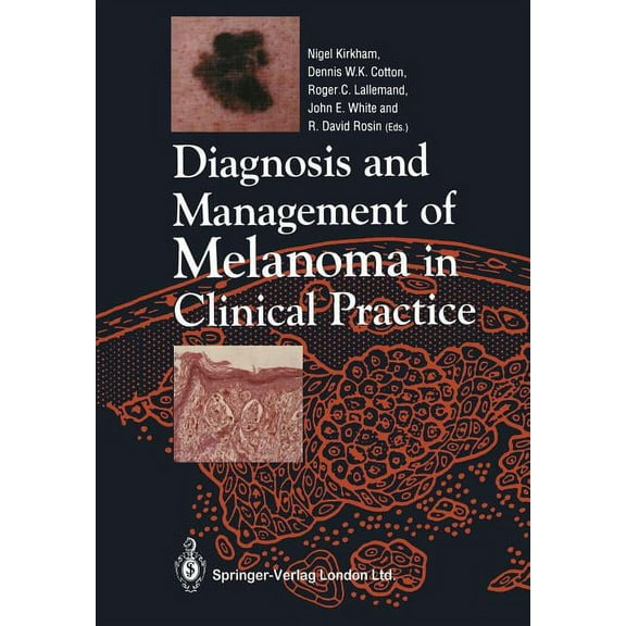 Diagnosis and Management of Melanoma in Clinical Practice, (Paperback)