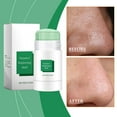 This Natural Remedy Clears Big Blackheads Like Magic - nonyje3