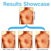 Pectus Excavatum Orthosis Brace with Automatic Air Pump, Pectus Excavatum Vacuum Bell for Sunken Chest, Thoracic Depression Support for All Ages