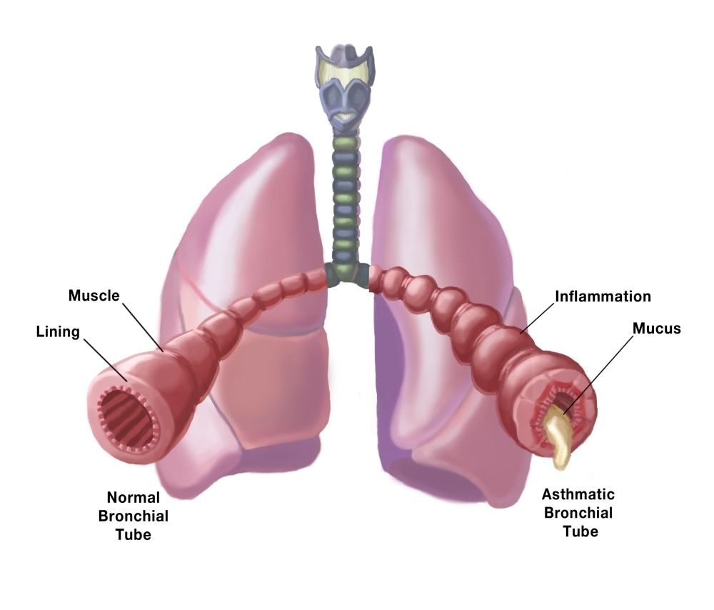 Normal vs. Asthmatic Bronchial Tubes Poster Print by Spencer