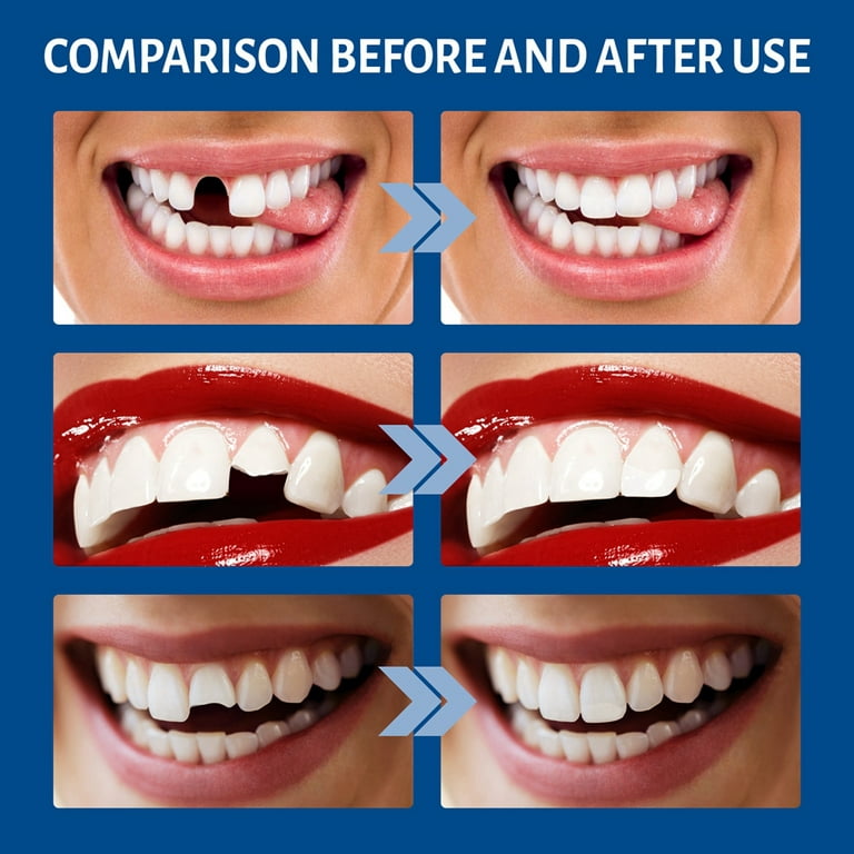 RuiKe Tooth Repair Kit, Temporary Teeth Replacement Kit Reusable Moldable  False Teeth For Tooth & Gaps Repair, Diy Crafts, Sculpting, Cosplay  Accessories, White, 1Oz 