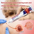 thumbnail image 3 of Pomada para eliminar verrugas genitales KanyeHB 20g Hierbas naturales Suave no irritante, 3 of 7