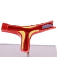 thumbnail image 6 of Equipment Human Vessel Atherosclerosis \ U0026 Thrombus Model School Teaching, 6 of 8