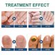 thumbnail image 4 of 96pcs Anti Fungal Nail Treatment-toe-fungus Onychomycosis Repair Sticker, 4 of 5