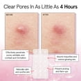 thumbnail image 3 of Parches para granos grace & stella Hydrocolloid, 36 unidades, 3 of 9