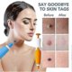 thumbnail image 4 of Skin-Tag Remover Double Headed Pen Set, Multi-Purpose 2 in 1 Design,Fast Effective,Portable Convenient Manual, 4 of 5