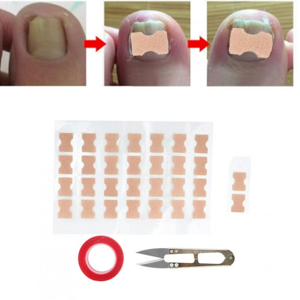Tebru Ingrown Nail Correction Sticker,DoubleSided Tape Toenail
