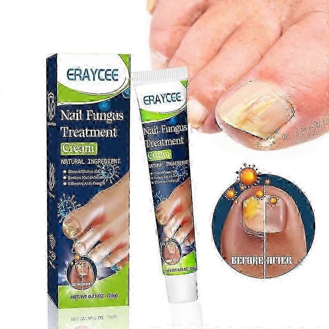 Nail Fungus Treatment Cream, 20g Toenail Fungus Treatment Cream, Strong Anti-Fungal Toenail Cream, Fungal Nail Treatment Cream