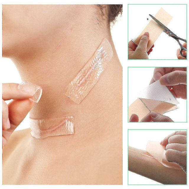 Parche de silicona para cicatrices Foohvr Placa de eliminación de cicatrices reutilizable Tono de piel 4 cm * 3 m