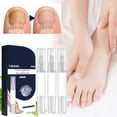 thumbnail image 4 of PiGOGI toenail Extra Strength Nail Repair Pen Repair Damaged Nails Yellow Discolored Thick and Ingrown Nails Pen for toenails and Fingernails with 3 Pens 12ml, 4 of 9
