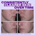 thumbnail image 6 of Differin Epiduo Pump 0.5oz with Adapalene 0.1% and Benzoyl Peroxide 2.5% Gel, 6 of 13