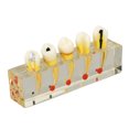 thumbnail image 1 of Modelo de diente de caries BuyWeekMX Modelo de dientes de enseñanza Compacto y liviano, 1 of 9