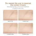 thumbnail image 3 of Acne Scar Removal Cream Stretch Marks Face Skin Cream Shrink Pores Gel-Fade Scar Marks Acne Cream Skin Care (Packaging Upgrade), 3 of 8