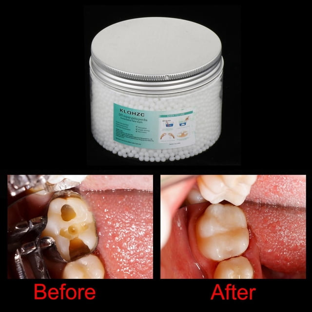 de reparación de relleno temporal Perlas de relleno térmico falso para chapa 300ml Macarena perlas de reparación de dientes