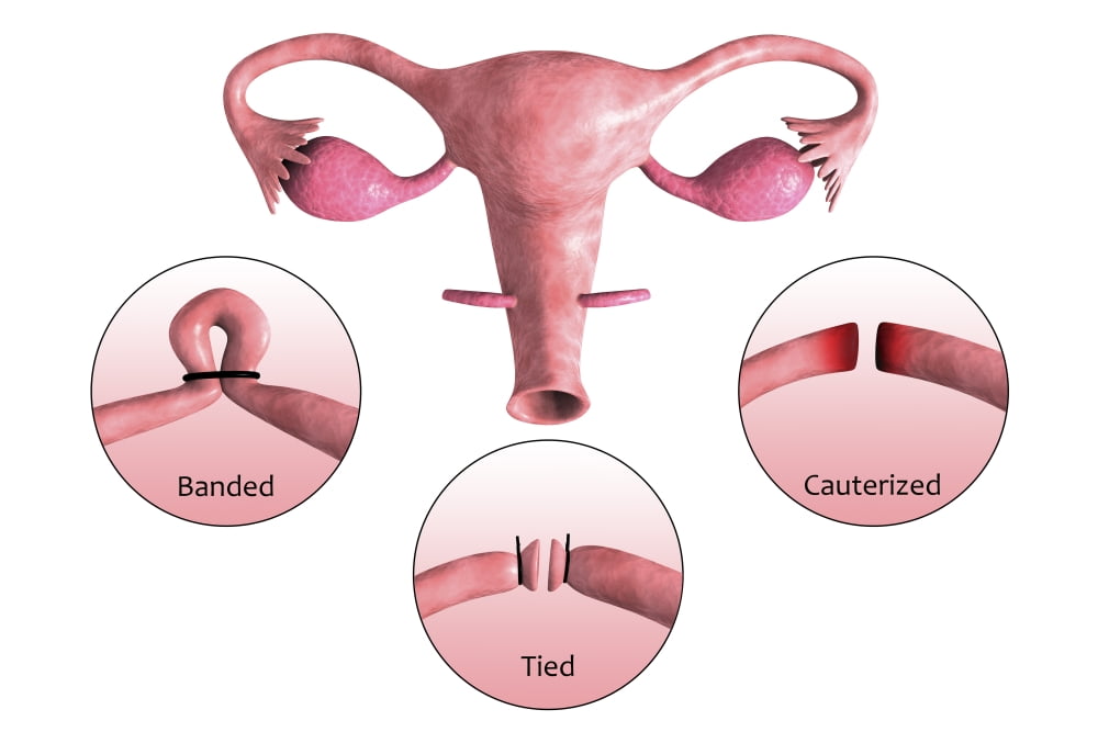 Biomedical illustration of a tubectomy A tubectomy is when a womans