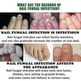 thumbnail image 4 of 2x 30ml Nails Care Repair Nail Fungal Anti-fungus Onychomycosis-removal Liquid Ginger Foot Antifungal Nail Treatments - Hz, 4 of 5