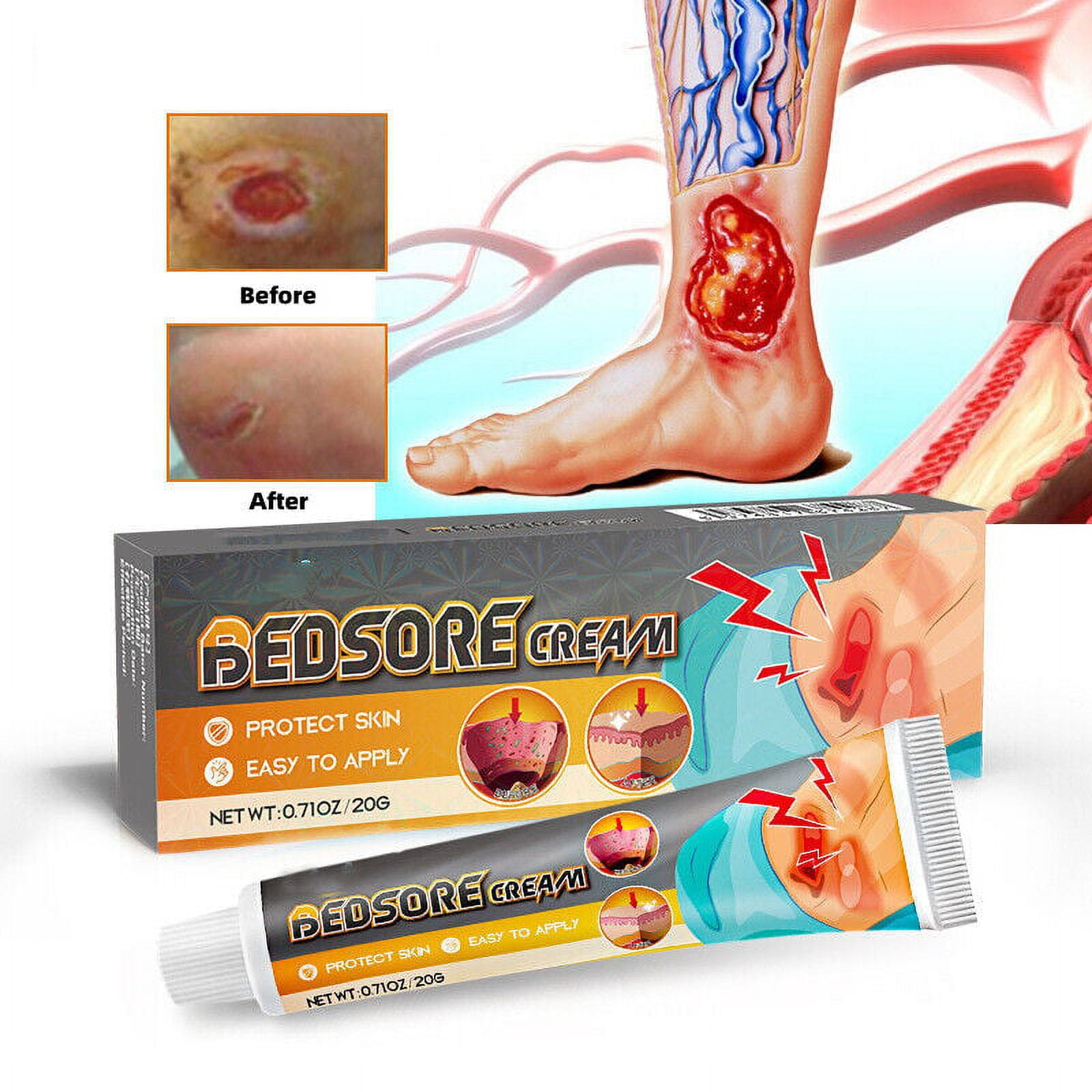 2pcs Bed Sore Cream Bedsore Ointment Bed Sores Fast Treatment Wound 20g