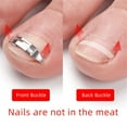 thumbnail image 3 of tssuouriy 3 Pieces Set Nail Corrector Recover Foot Care Not Tied Flesh Toenails, 3 of 6