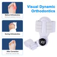 thumbnail image 3 of Toe Corrector Twist Adjustable Angle Painless and Bone-saving Universal for Left and Right Feet, 3 of 6