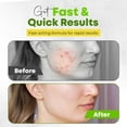thumbnail image 3 of Luminus Ultra Tea Tree Acne Serum, with Witch Hazel, High Strength 50ml, 3 of 8