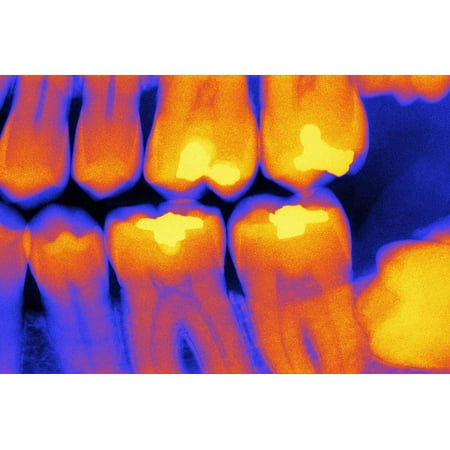 Teeth with Fillings, X-ray Print Wall Art By (Best Type Of Filling For Teeth)