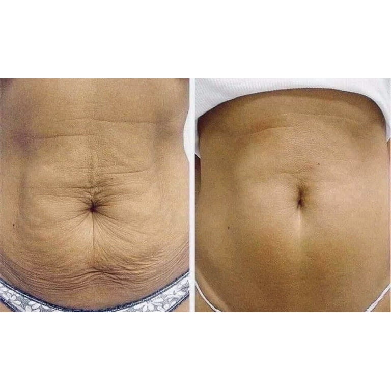 DEXONE ageLOC Dermatic Effects Firming Cream 5oz Cellulite