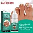 thumbnail image 2 of Tratamiento rápido de hongos en las uñas, suero para el cuidado de esencias, eliminación de hongos en las uñas de los pies, Gel para paroniquia y onicomicosis, 2 of 4