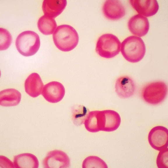Plasmodium Falciparum Slide, Smear