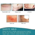 thumbnail image 4 of Gowinsee Silicone Scar Tape 1 Rolls, Silicone Scar Sheets Removal Strips for Acne, 4 of 5