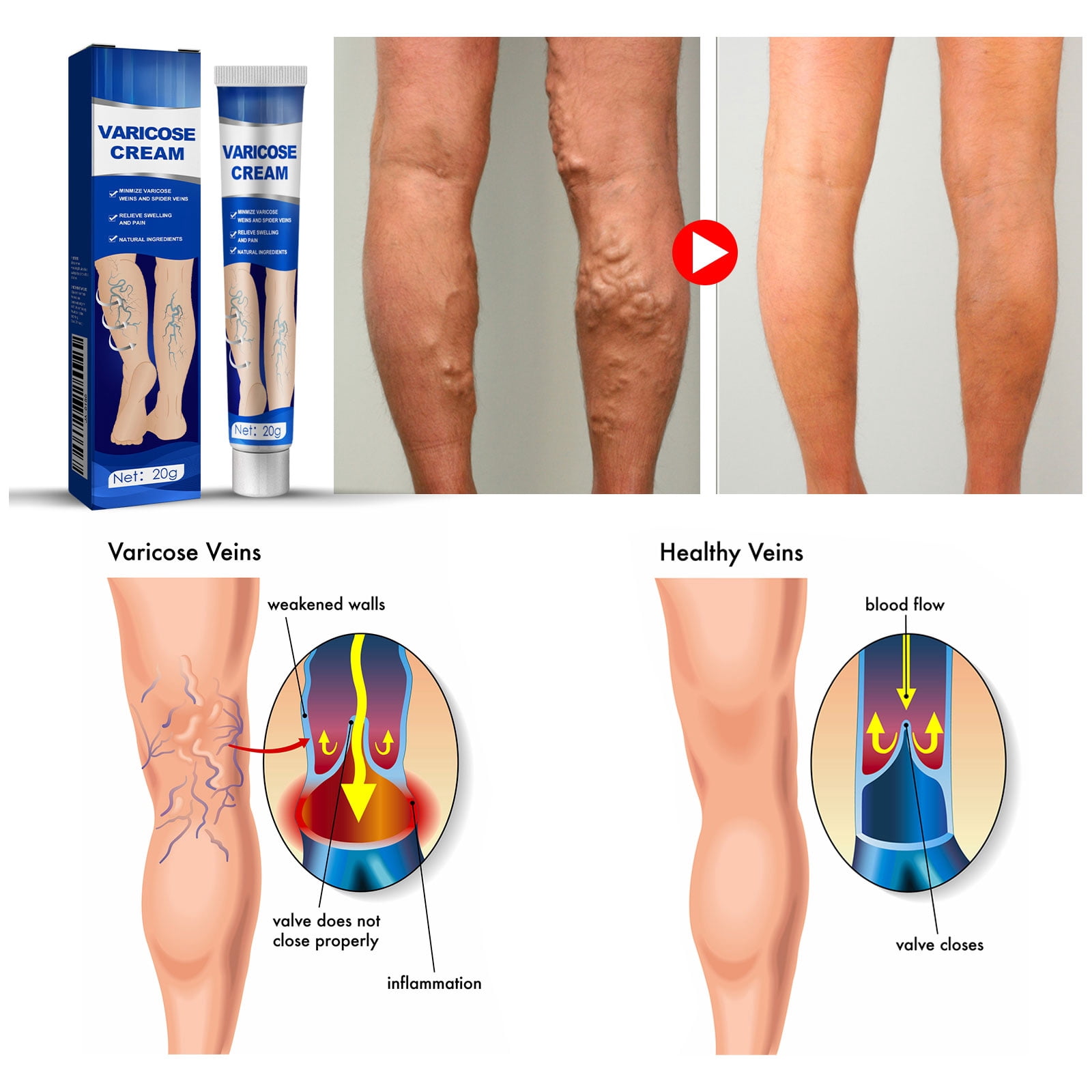 Alvantor Leg & Foot Varicose Cream, 0.7oz, Moisturizes & Relieves Discomfort, 0.7oz